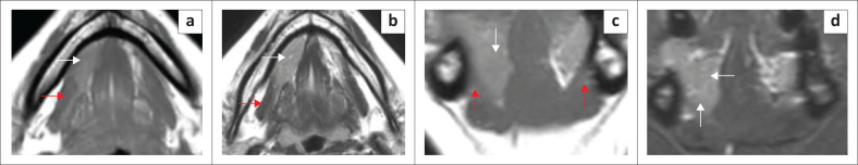 Imaging evaluation of the benign and malignant lesions of the floor of the mouth: Pictorial review.