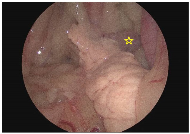 Laparoscopic partial pancreatectomy in a cat with exocrine pancreatic carcinoma.