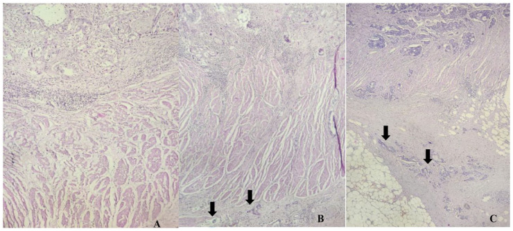 Prognostic Impact of Tumor Budding on Moroccan Gastric Cancer Patients.