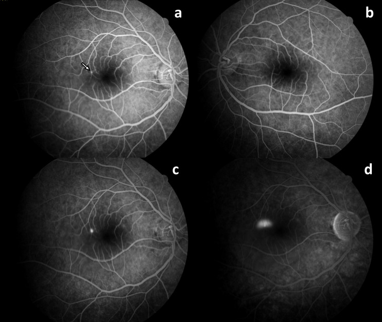 Central serous chorioretinopathy following oral quetiapine.