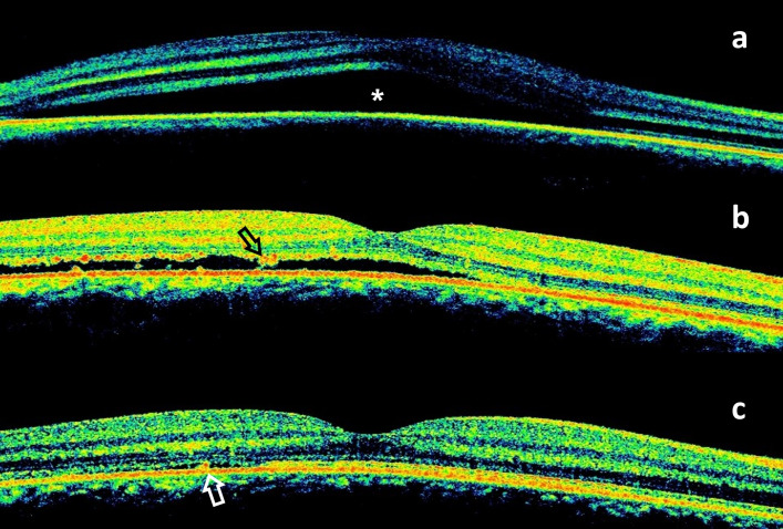 Central serous chorioretinopathy following oral quetiapine.