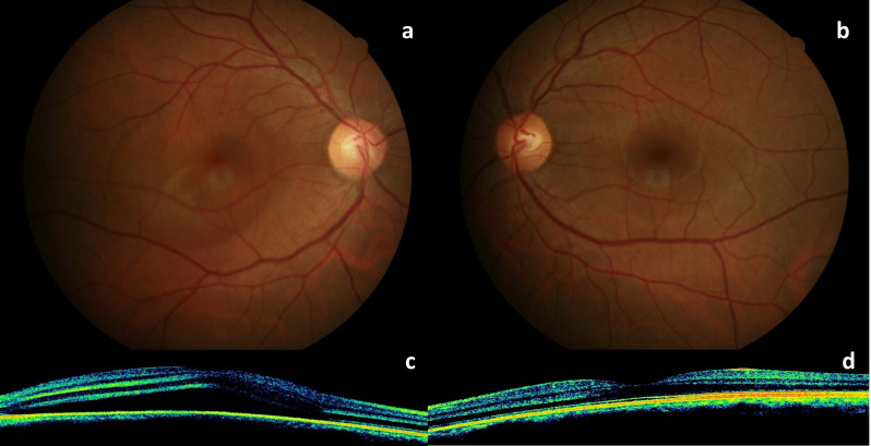 Central serous chorioretinopathy following oral quetiapine.