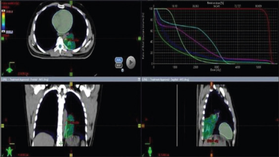 A Case Report on Rare Case of Pancreatic Metastasis from Primary Lung Adenocarcinoma: Treated Through a Non-surgical Approach.