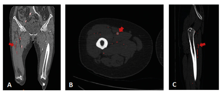 Anterolateral thigh perforator flap made by customized 3D-printing fabrication of fixed positioning guide for oromaxillofacial reconstruction: a preliminary study.