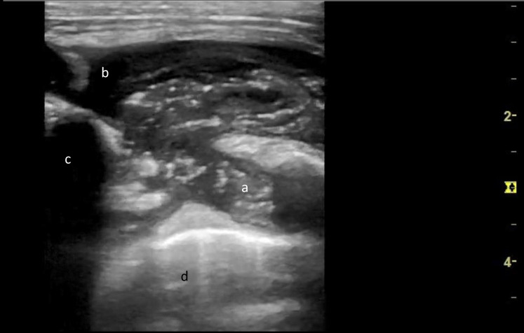 Sonographic Features of a Tuberculous Cold Abscess: A Case Report and Literature Review.