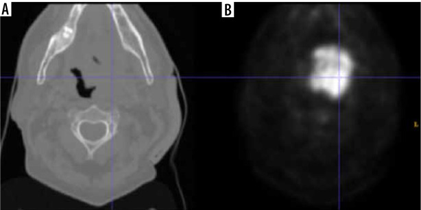 Auto-segmentation of head and neck tumors in positron emission tomography images using non-local means and morphological frameworks.