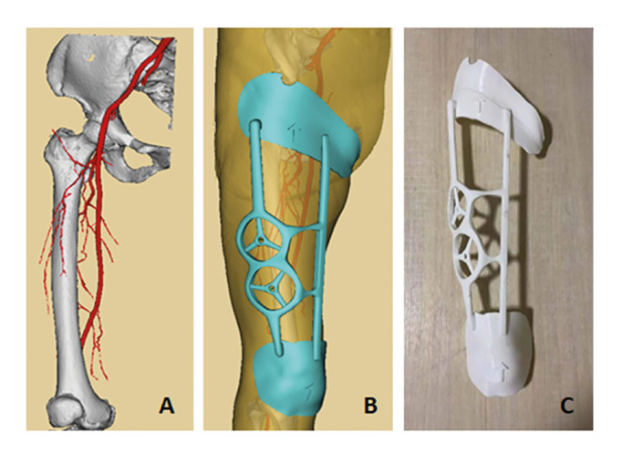 Anterolateral thigh perforator flap made by customized 3D-printing fabrication of fixed positioning guide for oromaxillofacial reconstruction: a preliminary study.