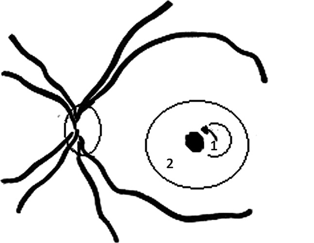 ILM peeling with ILM flap transposition vs. classic ILM peeling for small and medium macula holes-a prospective randomized trial.