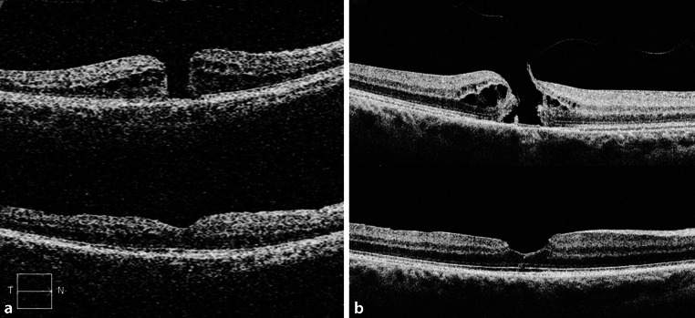 ILM peeling with ILM flap transposition vs. classic ILM peeling for small and medium macula holes-a prospective randomized trial.