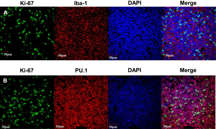 Myeloid sarcoma incidentally found in lymph nodes dissected for advanced gastric cancer.