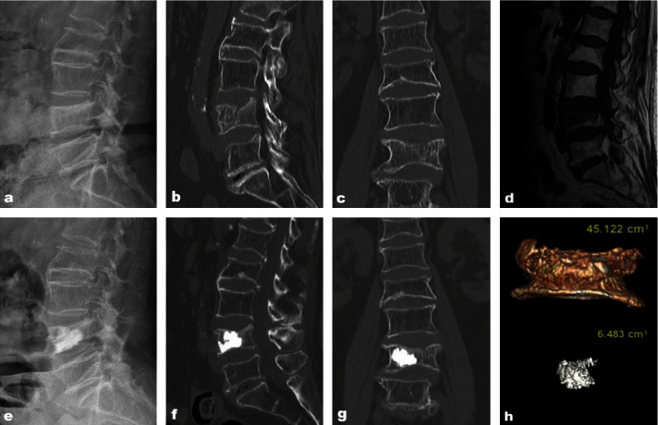 Correlation Analysis between Residual Pain after Vertebral Augmentation and the Diffusion Distribution of Bone Cement: A Retrospective Cohort Study.