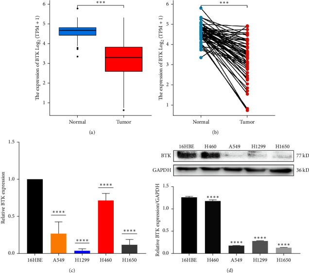 Overexpression of Bruton Tyrosine Kinase Inhibits the Proliferation, Migration, and Invasion of Non-Small Cell Lung Cancer Cells.