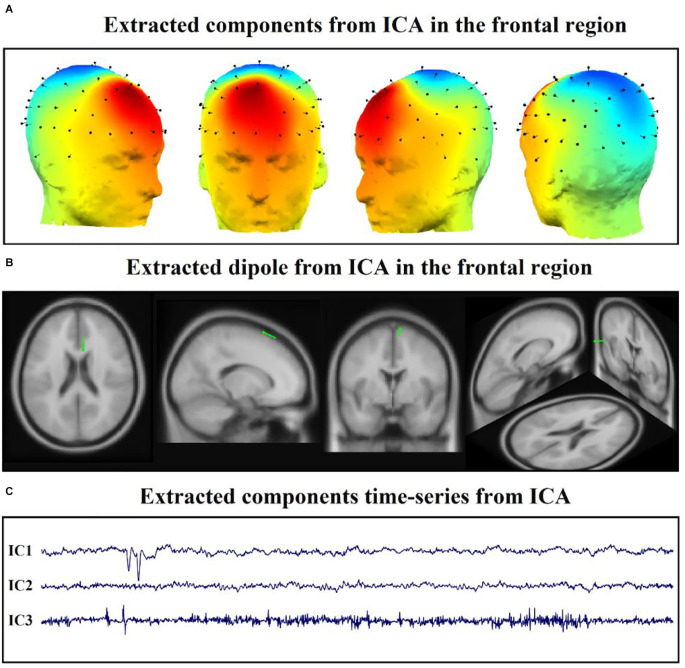 Machine learning approaches and non-linear processing of extracted components in frontal region to predict rTMS treatment response in major depressive disorder.