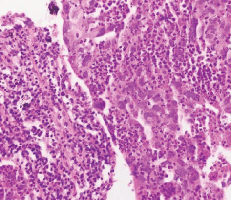 A Case Report on Rare Case of Pancreatic Metastasis from Primary Lung Adenocarcinoma: Treated Through a Non-surgical Approach.