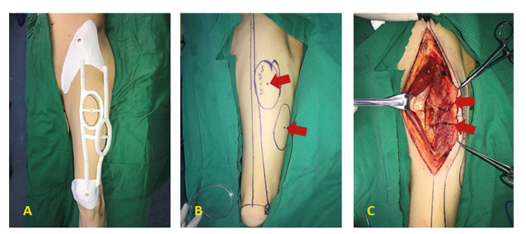 Anterolateral thigh perforator flap made by customized 3D-printing fabrication of fixed positioning guide for oromaxillofacial reconstruction: a preliminary study.