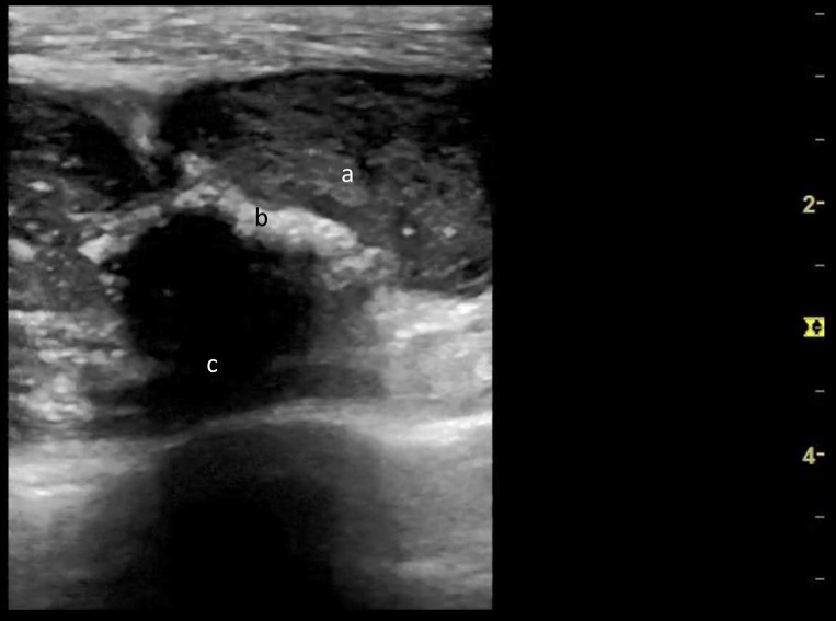 Sonographic Features of a Tuberculous Cold Abscess: A Case Report and Literature Review.