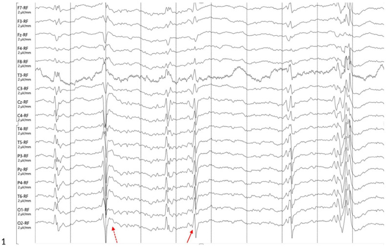 Electroencephalographic patterns in a mechanically ventilated cat with permethrin intoxication.