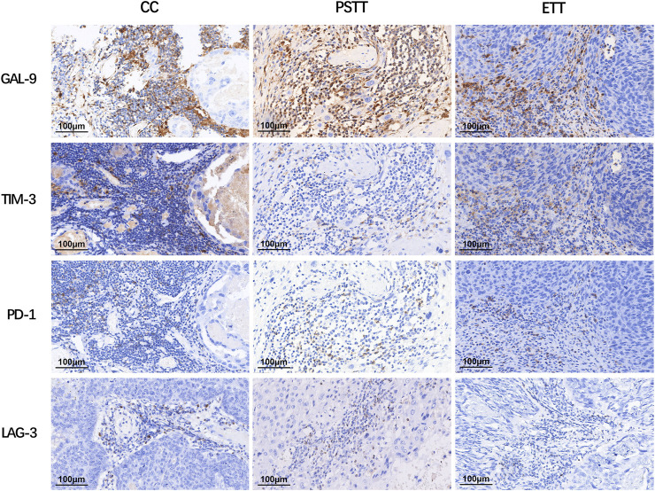 Expression of the immune targets in tumor-infiltrating immunocytes of gestational trophoblastic neoplasia.