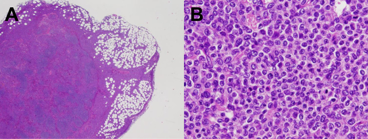 Myeloid sarcoma incidentally found in lymph nodes dissected for advanced gastric cancer.