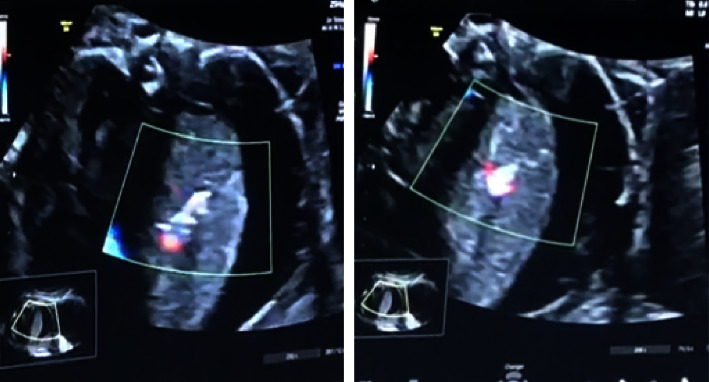 Successful Elective Thoracoscopic Resection of Complicate Extralobar Bronchopulmonary Sequestration after Intrafoetal Vascular Laser Ablation: The Paediatric Surgeon's Point of View.