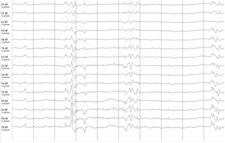 Electroencephalographic patterns in a mechanically ventilated cat with permethrin intoxication.