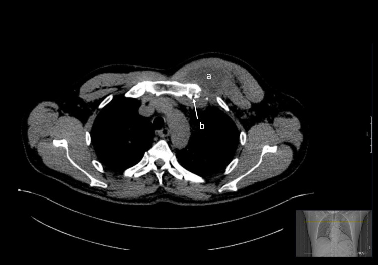 Sonographic Features of a Tuberculous Cold Abscess: A Case Report and Literature Review.