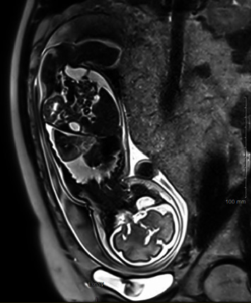 Successful Elective Thoracoscopic Resection of Complicate Extralobar Bronchopulmonary Sequestration after Intrafoetal Vascular Laser Ablation: The Paediatric Surgeon's Point of View.