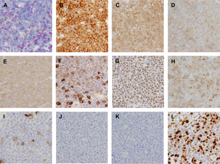 Myeloid sarcoma incidentally found in lymph nodes dissected for advanced gastric cancer.