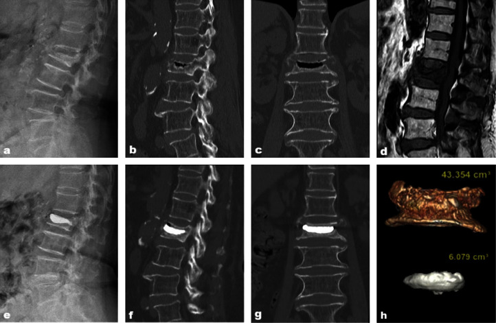 Correlation Analysis between Residual Pain after Vertebral Augmentation and the Diffusion Distribution of Bone Cement: A Retrospective Cohort Study.