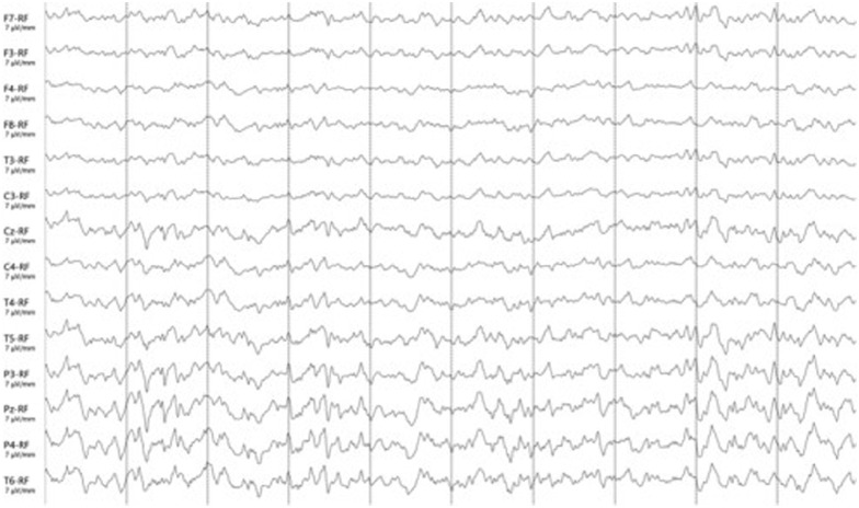 Electroencephalographic patterns in a mechanically ventilated cat with permethrin intoxication.