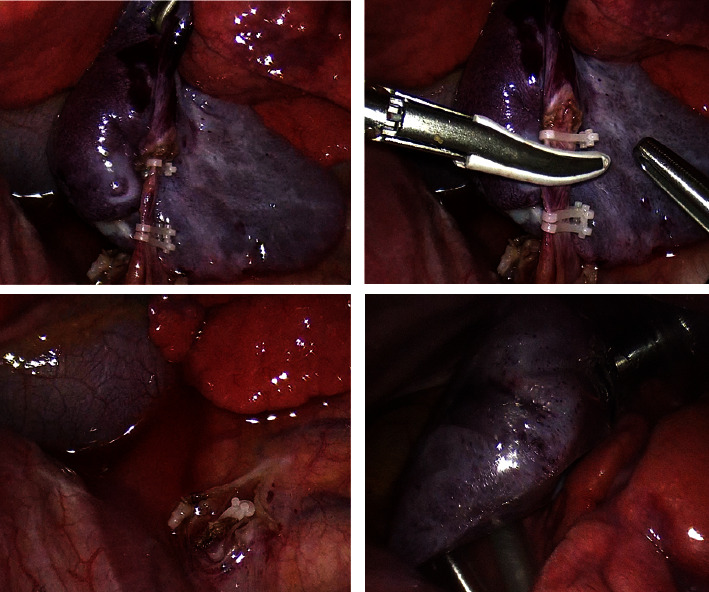 Successful Elective Thoracoscopic Resection of Complicate Extralobar Bronchopulmonary Sequestration after Intrafoetal Vascular Laser Ablation: The Paediatric Surgeon's Point of View.