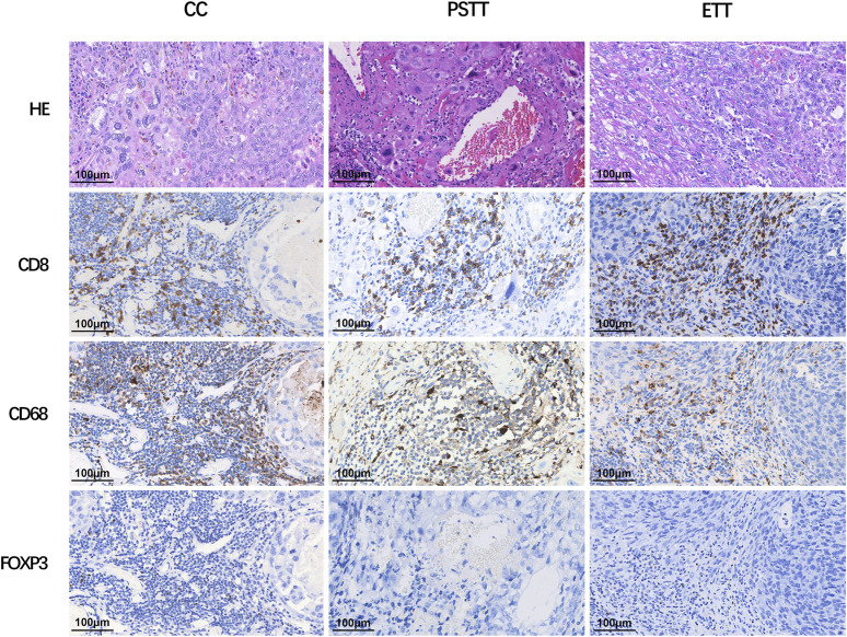 Expression of the immune targets in tumor-infiltrating immunocytes of gestational trophoblastic neoplasia.