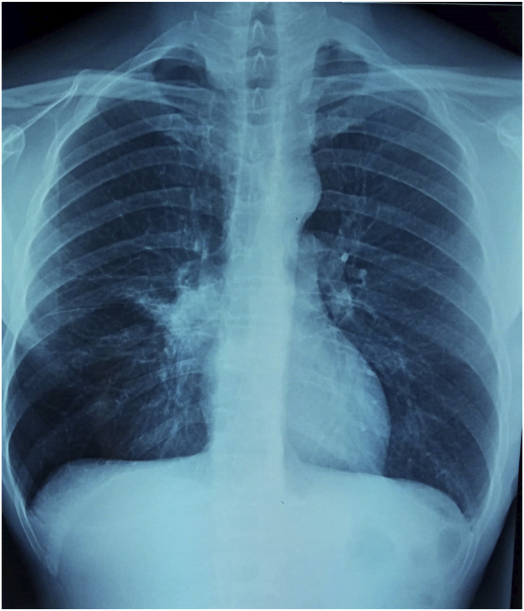 Granular cell tumor of the lung and tracheobronchial tree: Two case-presentation with a review of the literature.