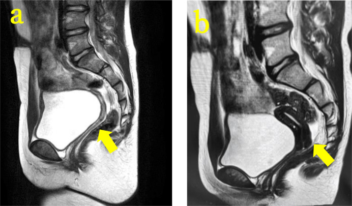 A case of 46,XY complete gonadal dysgenesis with a novel missense variant in <i>SRY</i>.