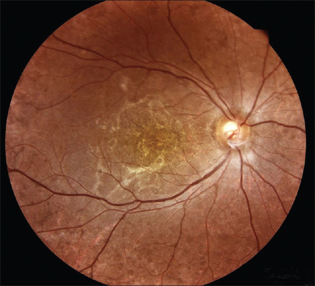 Clinical Course and Optical Coherence Tomography of Ocular Angiostrongyliasis: A Case Report.