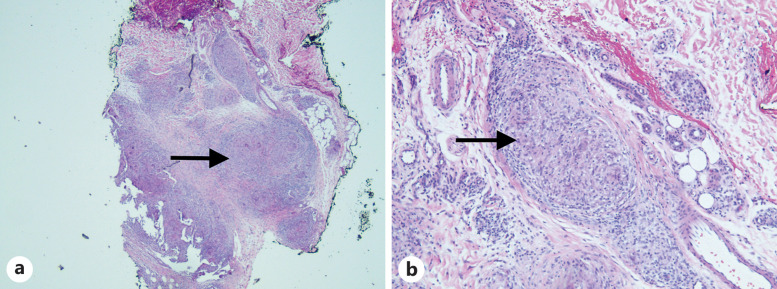 Cutaneous Manifestations of Sarcoidosis Seen in a Patient with a History of Tuberous Sclerosis.