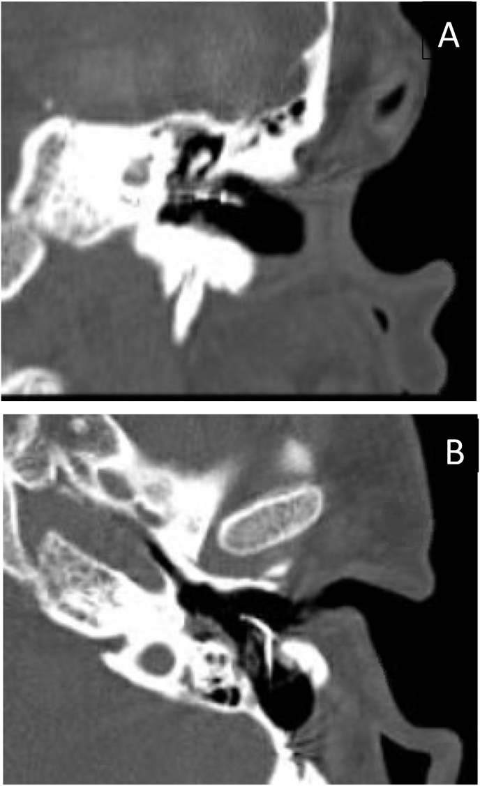 Long-term complications of the transmeatal approach (Open Transcanal) in cochlear implants: A follow-up study