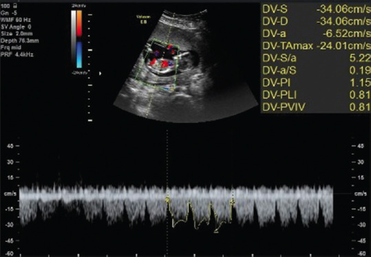 Reference values for ductus venosus Doppler velocity indices between 11 and 13+6 weeks of gestation: A single-center prospective study in Iran.