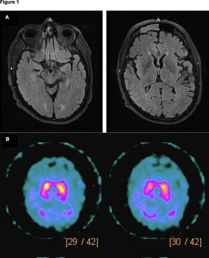 Globular glial tauopathy presenting clinically as atypical parkinsonism with dementia: A clinicopathological case report