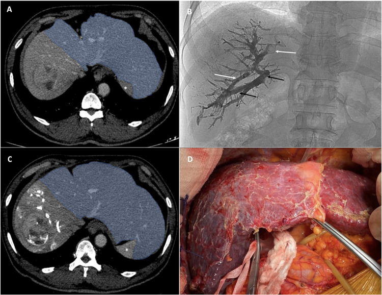 Safety and Efficacy of Liver Venous Deprivation Following Transarterial Chemoembolization Before Major Hepatectomy for Hepatocellular Carcinoma.