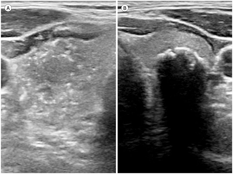 [Clinical Application of the 2021 Korean Thyroid Imaging Reporting and Data System (K-TIRADS)].