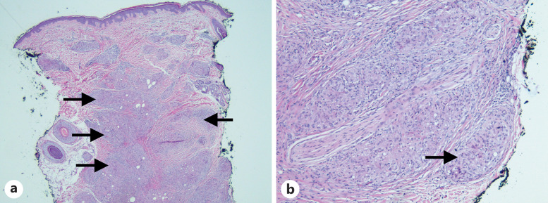 Cutaneous Manifestations of Sarcoidosis Seen in a Patient with a History of Tuberous Sclerosis.