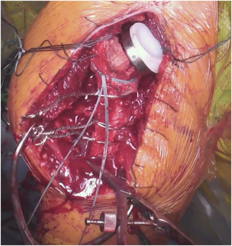 Arthroplasty as Primary Treatment for Metadiaphyseal Proximal Humerus Fractures: A Viable Alternative to Osteosynthesis for the Elderly.