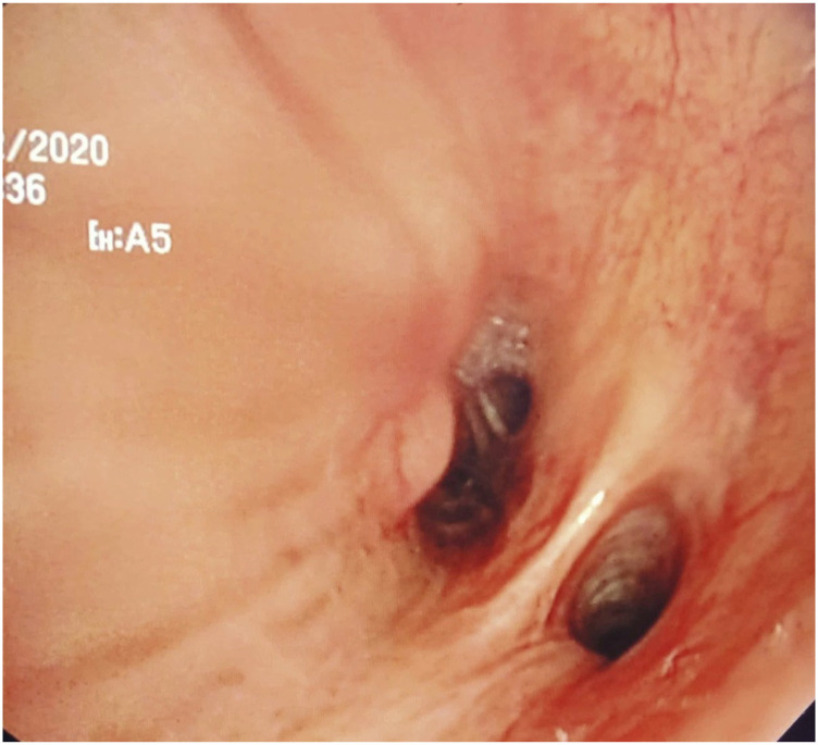 Granular cell tumor of the lung and tracheobronchial tree: Two case-presentation with a review of the literature.