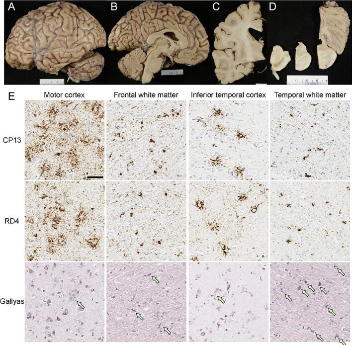 Globular glial tauopathy presenting clinically as atypical parkinsonism with dementia: A clinicopathological case report