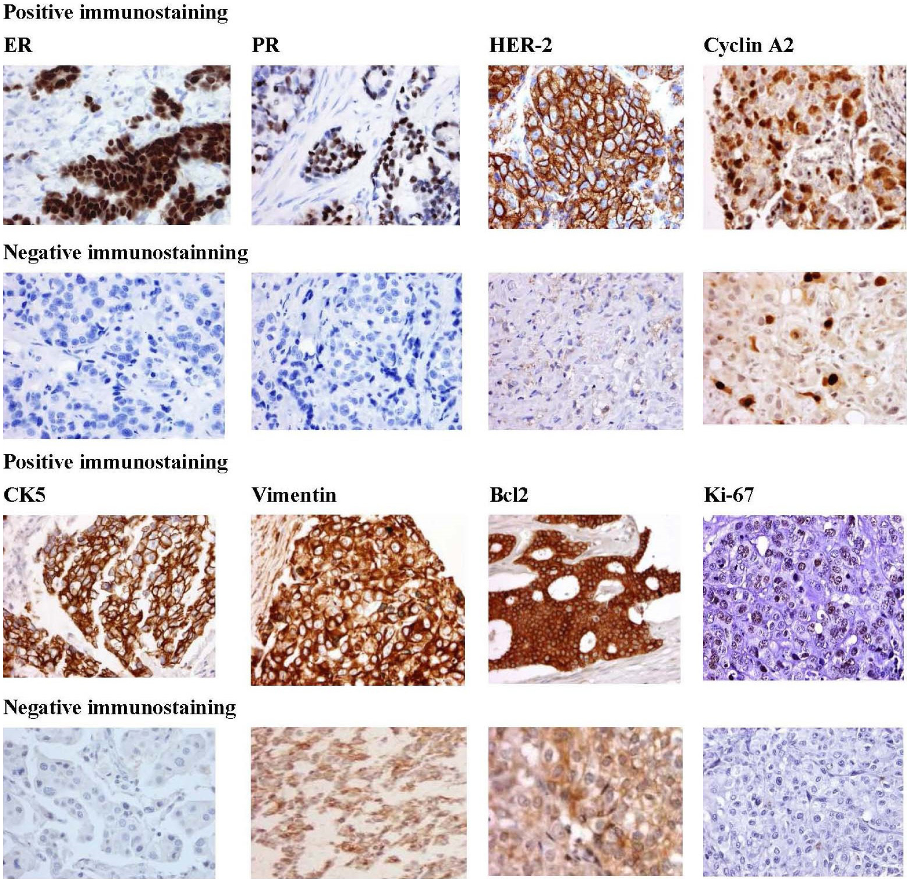 Cyclin A2 and Ki-67 proliferation markers could be used to identify tumors with poor prognosis in African American women with breast cancer.