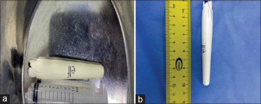 Extraction of foreign body from the urinary bladder using nephroscope: A case report of endoscopy treatment.