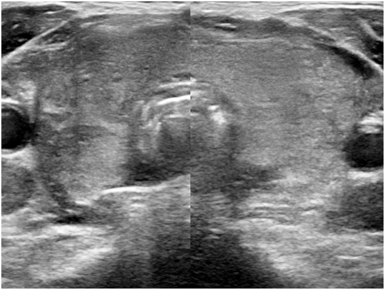 [Clinical Application of the 2021 Korean Thyroid Imaging Reporting and Data System (K-TIRADS)].