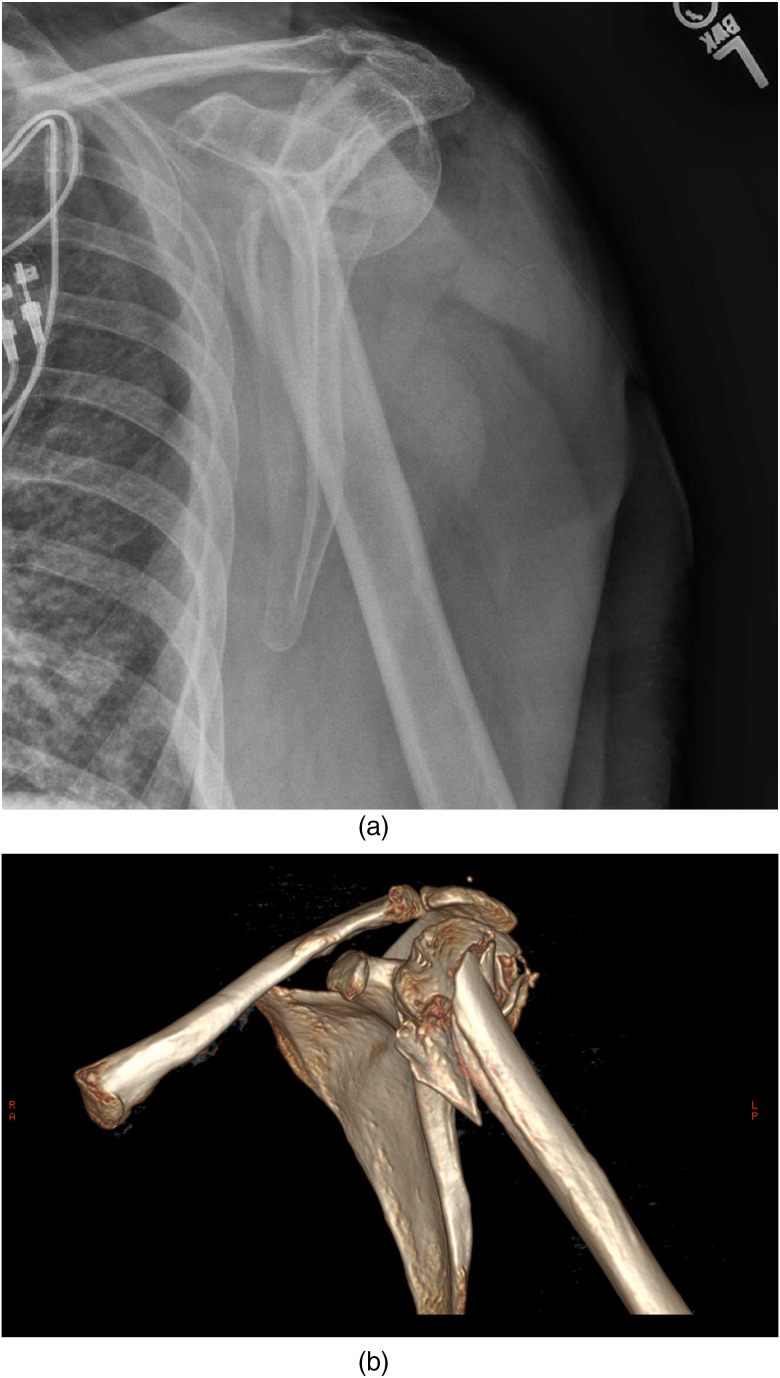 Arthroplasty as Primary Treatment for Metadiaphyseal Proximal Humerus Fractures: A Viable Alternative to Osteosynthesis for the Elderly.