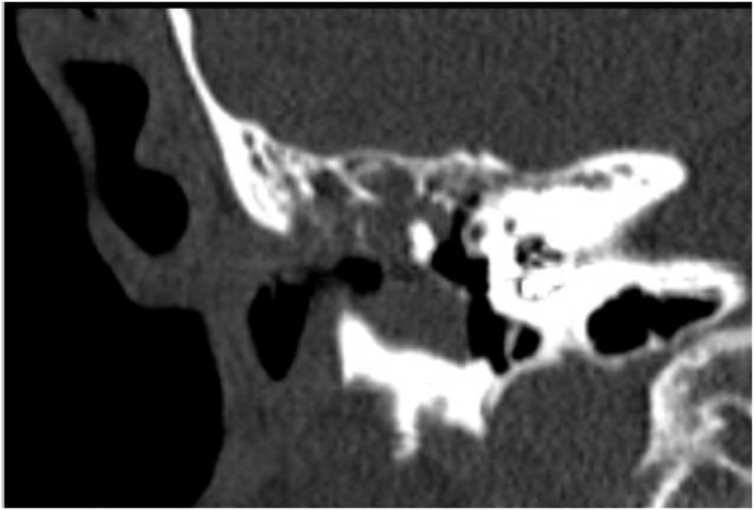 Long-term complications of the transmeatal approach (Open Transcanal) in cochlear implants: A follow-up study